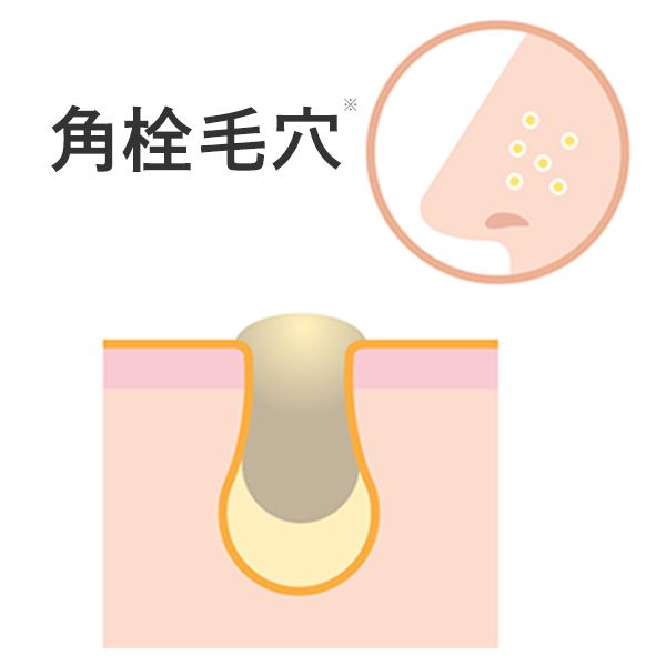 角栓毛穴のイメージ