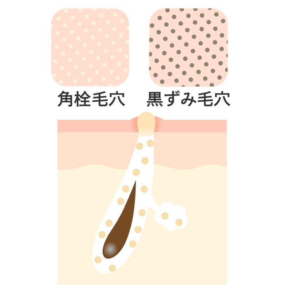 皮脂が多いときの毛穴のイメージ